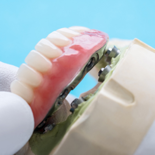 Hybrid Dentures Fabrication